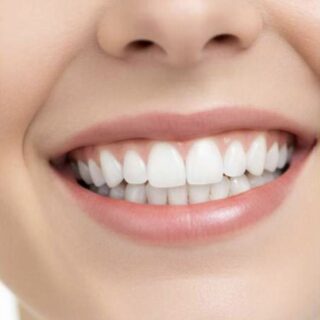 45 Minutes Whitening Treatment - Smart Deal